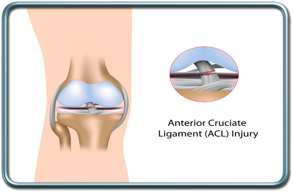 קרע ברצועה הצולבת הקדמית- anterior cruciate ligament (ACL) tear