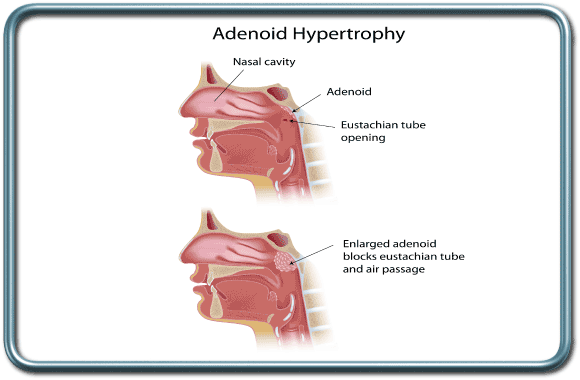 הגדלת האנדואידים- Adenoid hypertrophy