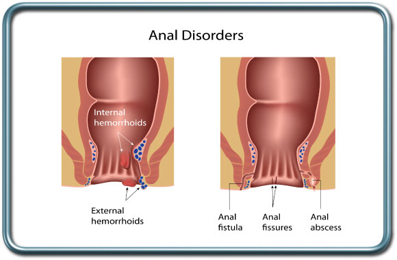 הפרעות אנאליות- Anal procedures