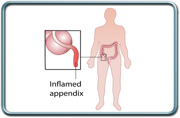כריתת תוספתן- Appendectomy