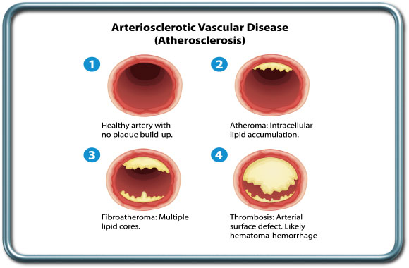 טרשת עורקים (אתרוסקלרוזיס)