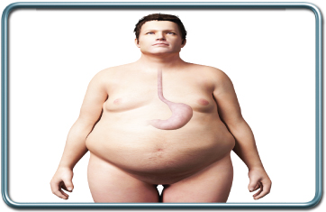 bariatric surgery