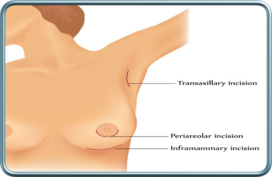 חתכים בניתוחי שד- Breast surgery sections