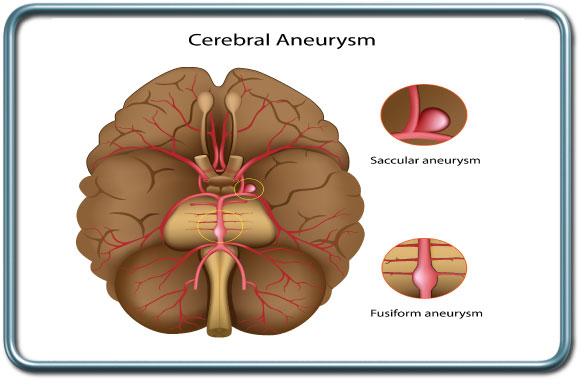 מפרצת (אנויריזמה) צרברלית- Cerebral aneurysm
