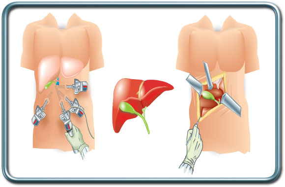 כריתת כיס מרה לפרוסקופית לעומת פתוחה- Laparoscopic vs open cholecystectomy