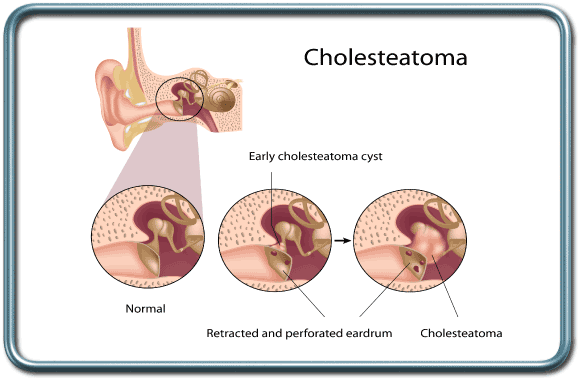 כולהסטאטומה- Cholesteatoma