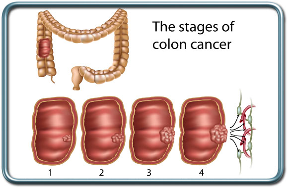 שלבי סרטן המעי הגס- Colon Cancer stages