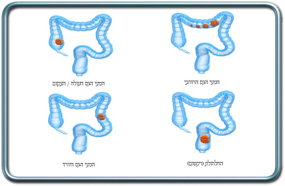 גידולי המעי הגס- Colon Cancer