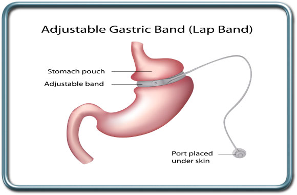 ניתוח טבעת- Gastric banding