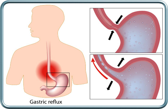 רפלוקס- Gastric reflux