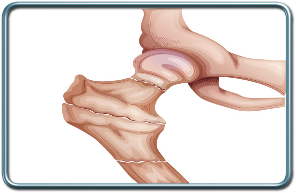 שברי צוואר הירך- Femur neck fractures