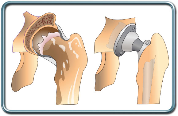 החלפת מפרק ירך מלאה- total hip replacement- THR