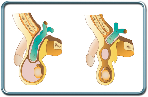 בקע מפשעתי (Inguinal hernia) עם לולאת מעי דק בשק הבקע