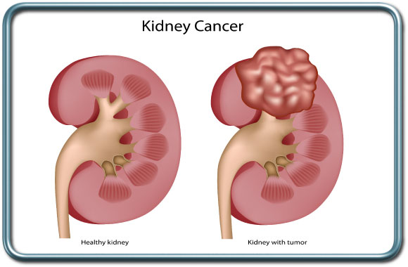 סרטן הכליה- Kidney cancer- Renal cell carcinoma (RCC)