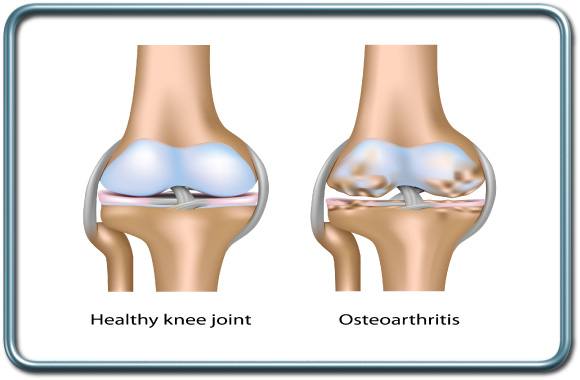אוסטאוארתריטיס של מרפק הברך- Knee osteoarthritis