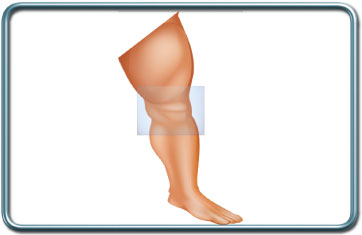ניתוחי ברך- Knee surgery
