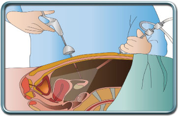 סיבוכי ניתוחים לפרוסקופים- Laparoscopic surgery complications