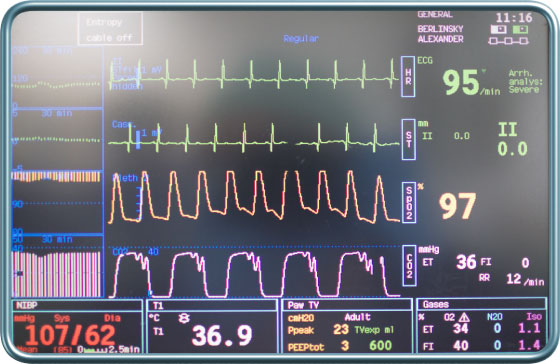 מוניטור הרדמה- hemodynamic monitor