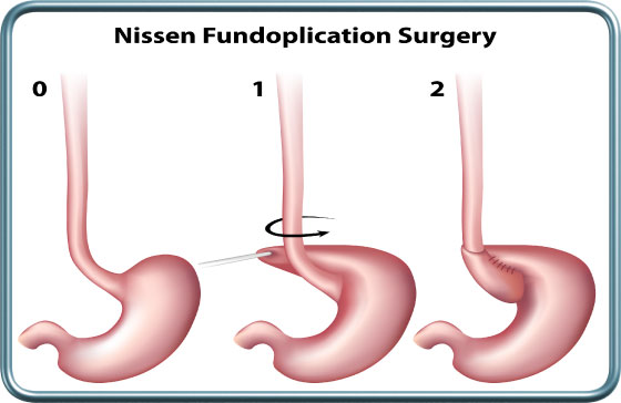 ניסן פונדופליקציה- Nissen Fundoplication surgery
