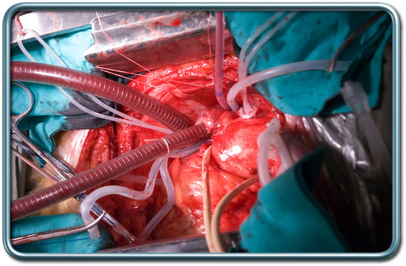 ניתוח מעקפים עם מכונת לב ריאה