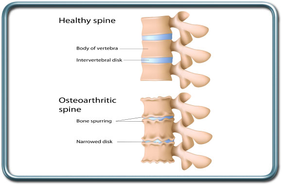 אואוסטיאוארתריטיס של עמוד השדרה- Spine osteoarthritis