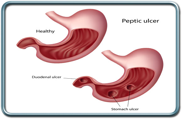 כיב קיבה וקכיב תרסריון- Gastric and duodenal ulcers