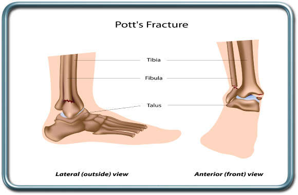 שבר בקרסול- ankle fracture