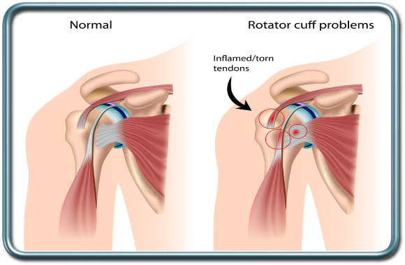 קרע של ה- rotator cuff- Rotator cuff tear