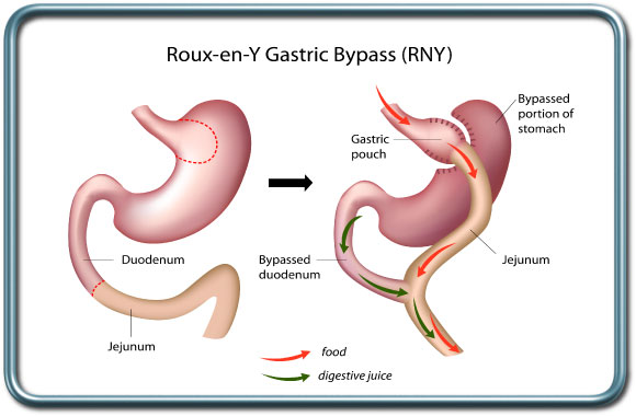 ניתוח מעקף קיבה- Gastric bypass