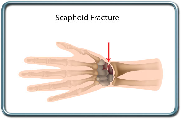 שבר בעצם הסירה- הסקפואיד- Scaphoid fracture