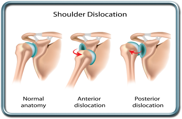 פריקה קדמית או אחורית של הכתף- shoulder dislocation