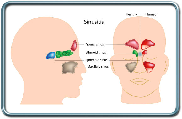 סינוסיטיס- Sinusitis