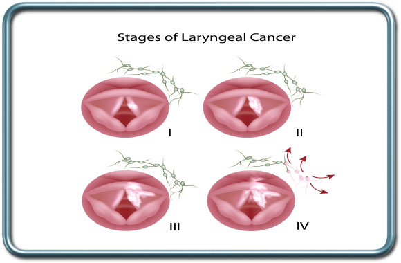 שלבי סרטן בית הקול- Laryngeal cancer stages