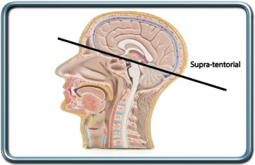 ניתוחים סופראטנטוריאלים- Supratentorial procedures