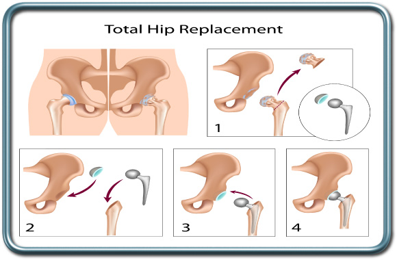 החלפת מפרק ירך מלאה- total hip replacement- THR
