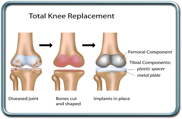 החלפת מפרק ברך- total knee replacement - TKR