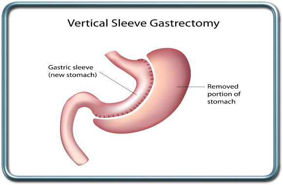 ניתוח שרוול- Sleeve gastrectomy